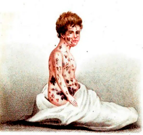 bexiga variola